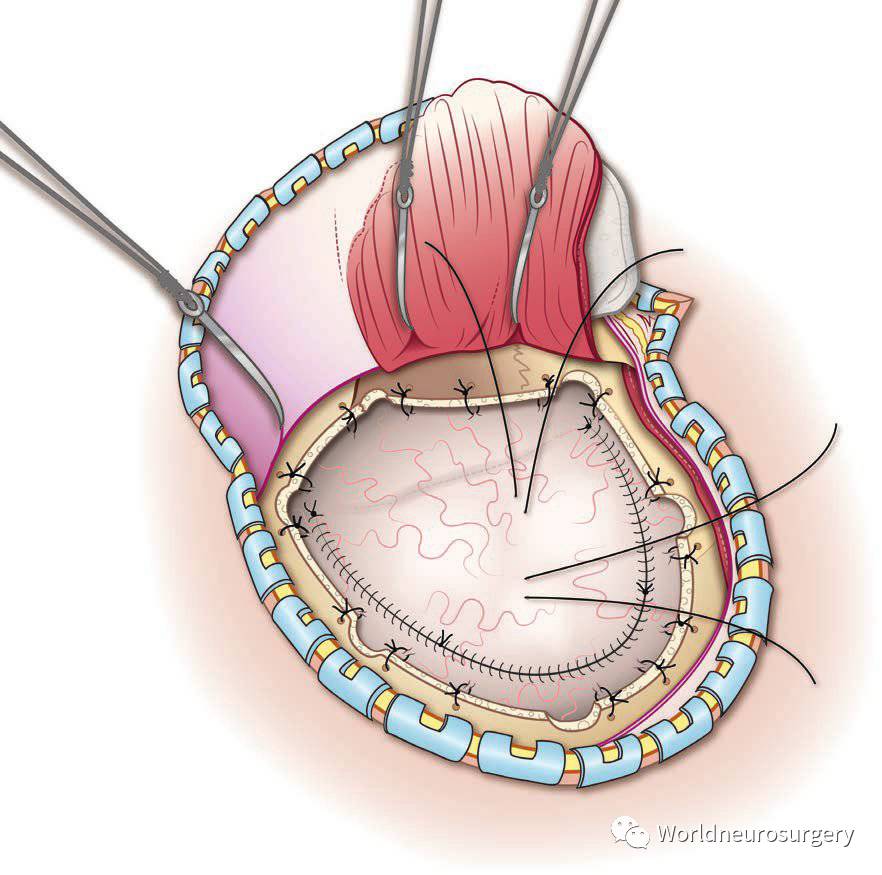 硬膜外及硬膜下血肿的手术治疗atlasofemergencyneurosurgery系列第