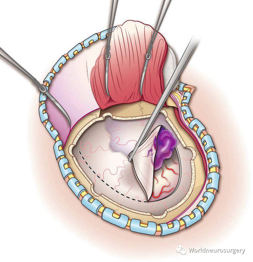 硬膜外及硬膜下血肿的手术治疗atlasofemergencyneurosurgery系列第