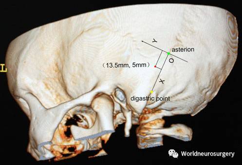 神外医生基本功-利用三维ct定位横窦-乙状窦交角-neurosurg rev