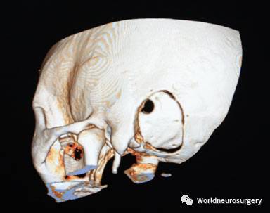 7 术后3d ct骨成像显示了钻孔就位于术前设计的横窦-乙状窦沟交点的