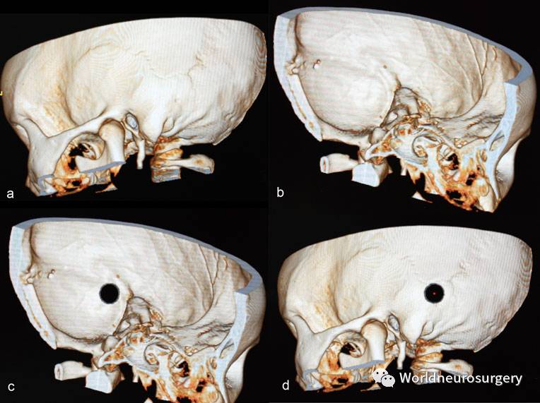 神外医生基本功--利用三维ct定位横窦-乙状窦交角--neurosurg rev