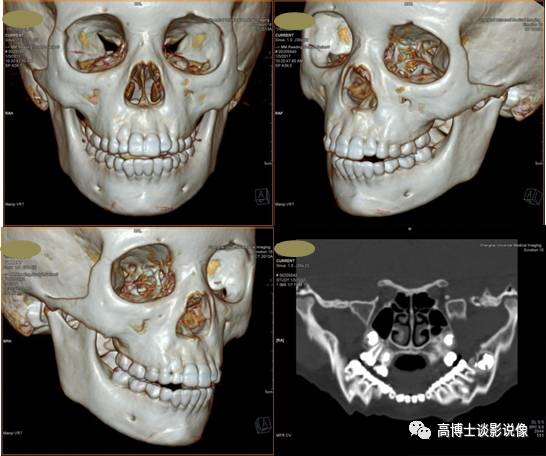 可以作为艺术作品欣赏的ct三维重建技术