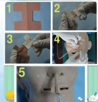 怎么拔鼻腔引流管胃管术（二）_https://www.jmylbn.com_新闻资讯_第11张