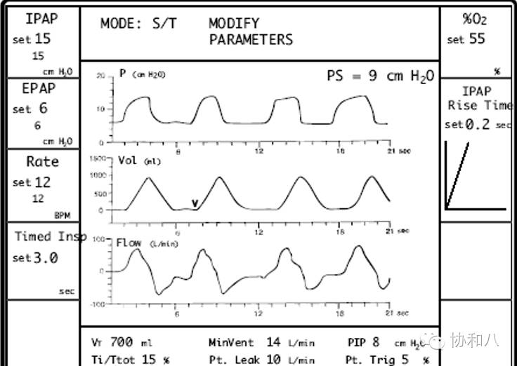bipap英语怎么读解读BiPAP（1）：奄奄一息时，你的呼吸谁做主 ｜ 一页手册·协和八_https://www.jmylbn.com_新闻资讯_第3张