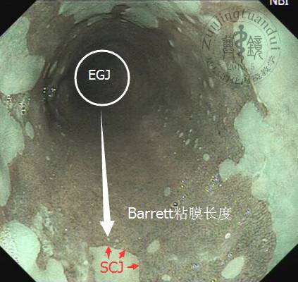 《barrett粘膜长度》《barrett粘膜全周性上移的长度》barrett分型