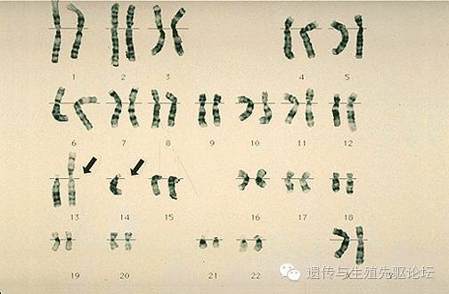 罗氏易位染色体核型图