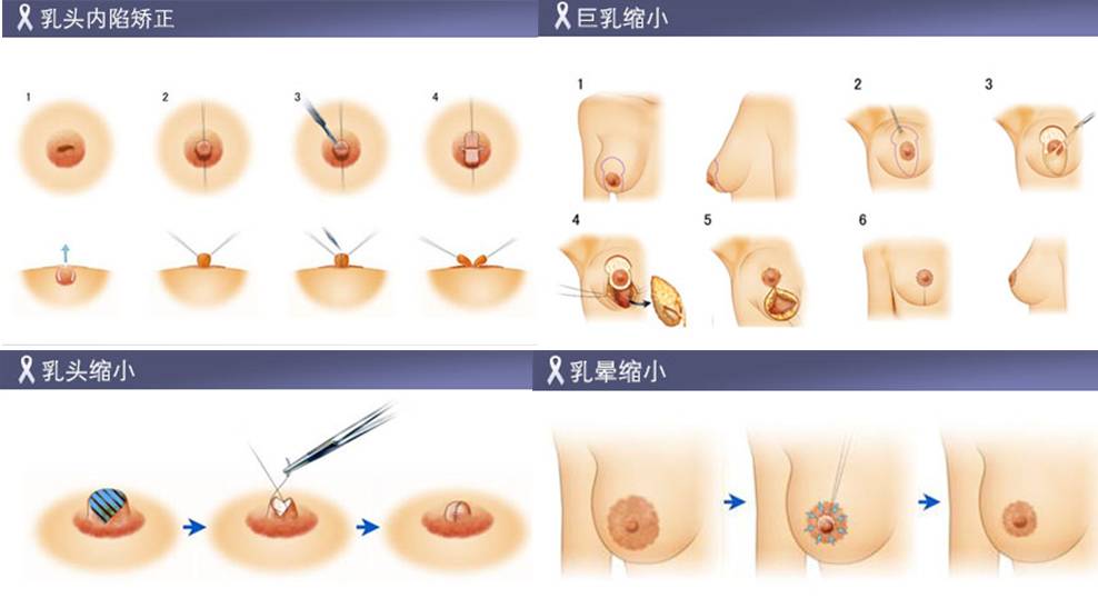 另一种是乳房塑形悬吊术,适用于轻度乳房下垂并伴有萎缩者