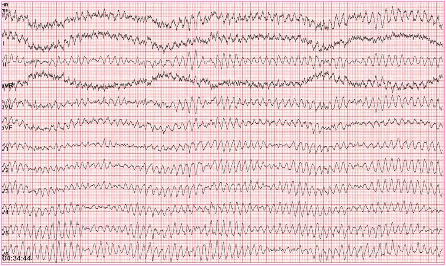 图5. 室颤心电图:大小不等,极不匀齐的快频率波,频率达200~500次/分.