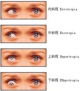 宝宝一直歪着头？这些斜视的信号家长要当心