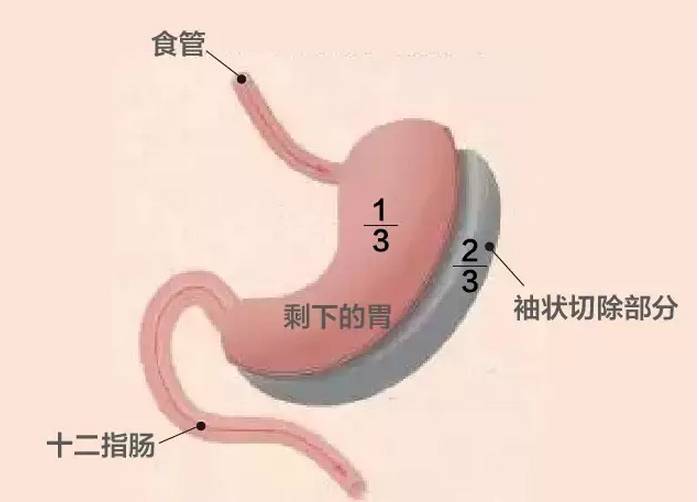 袖状胃切除术是在腹腔镜下将胃纵行切除,切除胃底,缩小胃的容积.