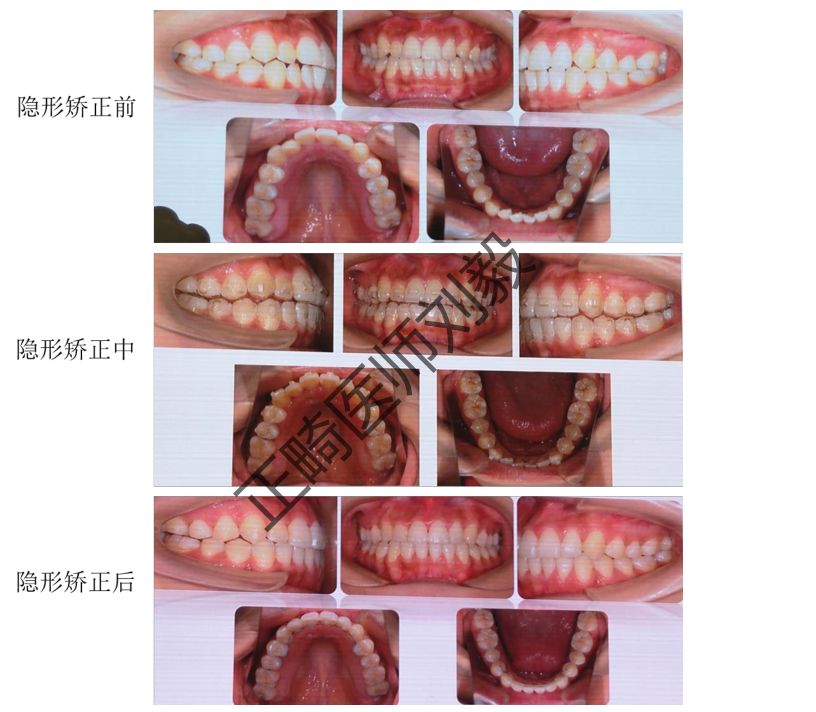 种植支抗与牵引)与复诊策略(理论 6 隐形矫正病例分析,方案审核与