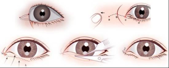 开眼角图