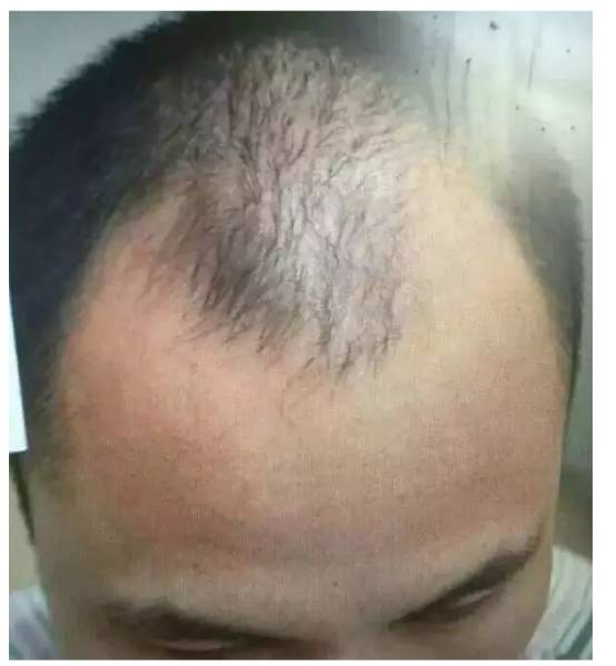 秋季来临,脑门高,脱发秃顶,眉睫毛稀少的武汉朋友们,都去做了这件事