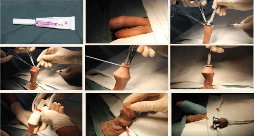 以5例一次性包皮环切缝合器进行包皮环切手术的效果图