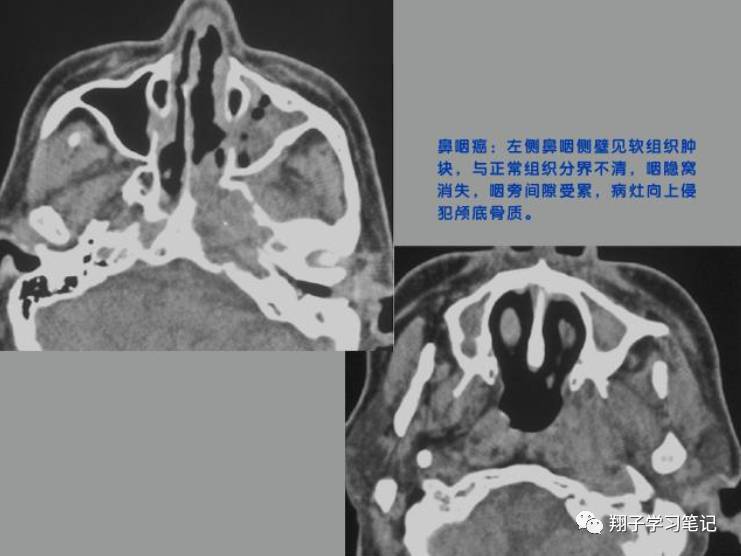 鼻咽腔变形,不对称:鼻咽癌好发于咽隐窝,一侧咽隐窝消失,变平为最常见