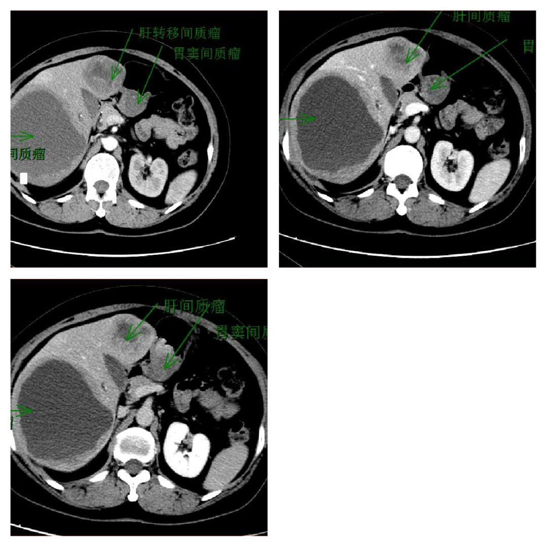 肝癌胰腺癌转移瘤一文理清肝胆胰常见疾病的ct鉴别诊断