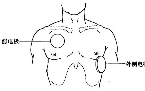 为什么选择双相波心脏电复律你不知道的事_https://www.jmylbn.com_新闻资讯_第15张