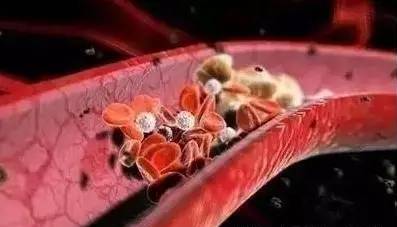 血管堵塞，癌症源头，每天喝黑茶，让血管畅通无阻！