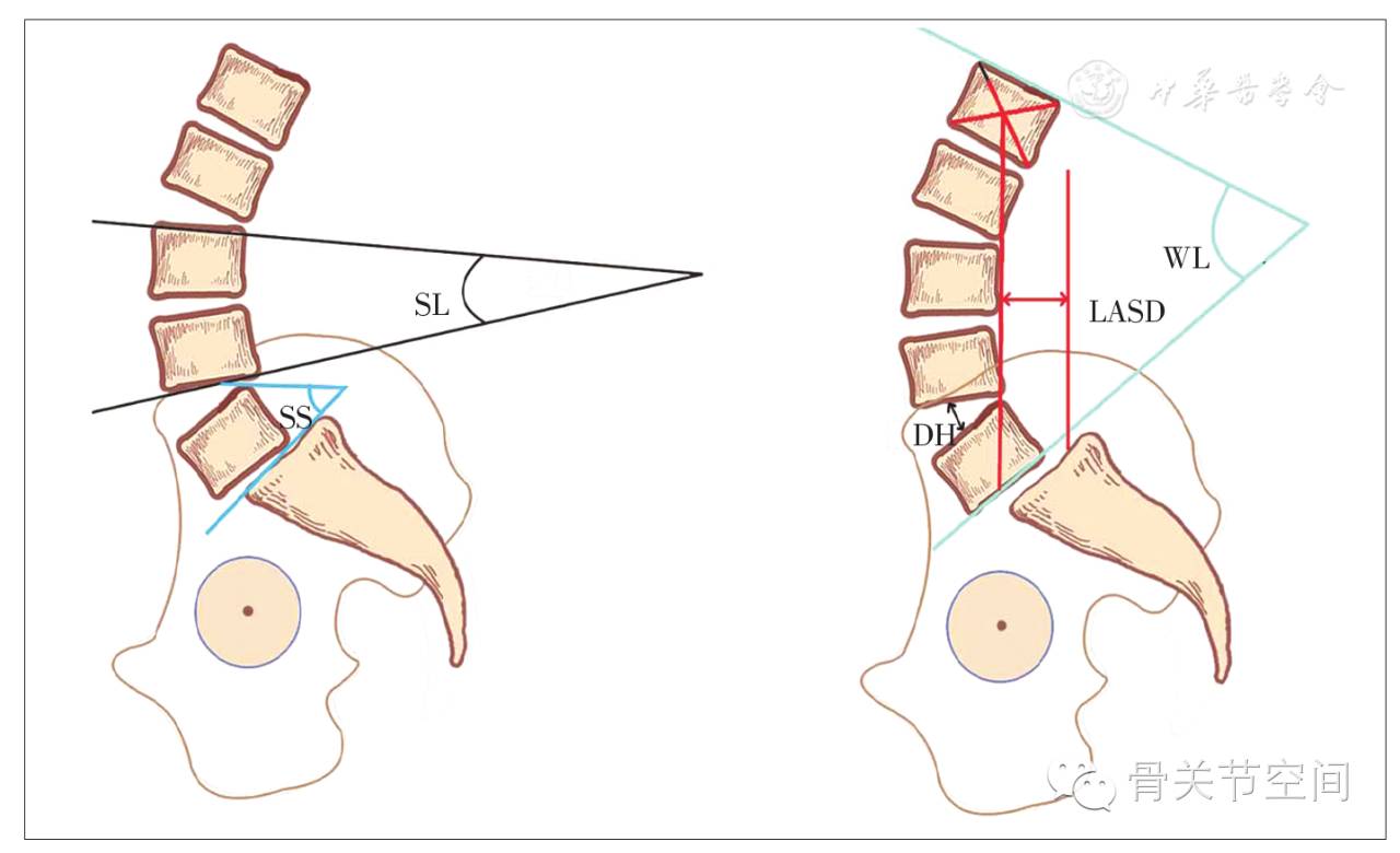 腰椎前凸角(whole lumbar lordosis angle,wl,侧位x线片示l1与s1上