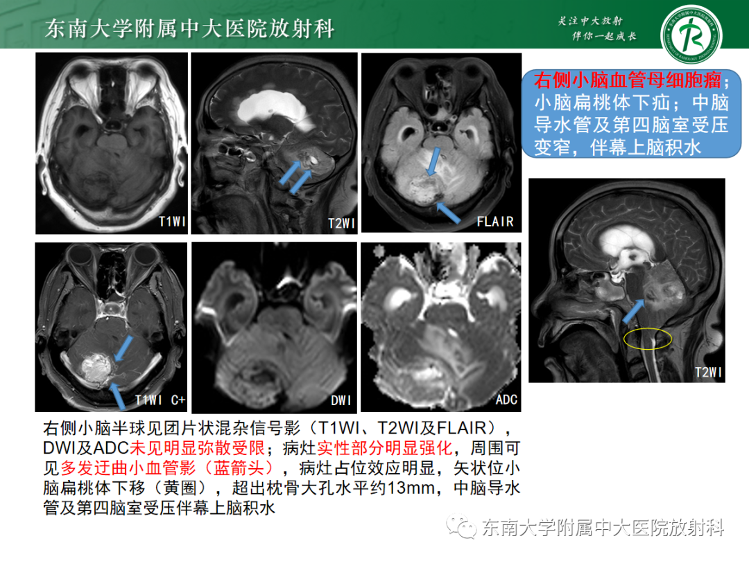 成人小脑血管母细胞瘤影像诊断与鉴别