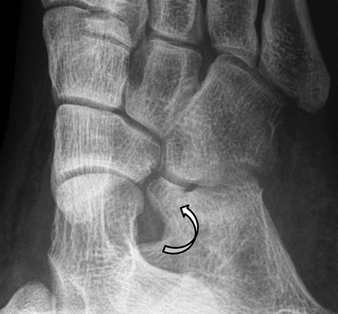 图 7b - 脚的斜位片识别骨折(箭头).图 8a- 1型骨折与愈合2例.