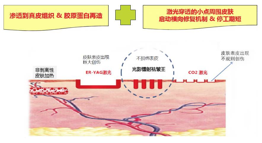 穿透力强,无痛感,无创伤,深度约达到2mm但不伤及皮肤组织