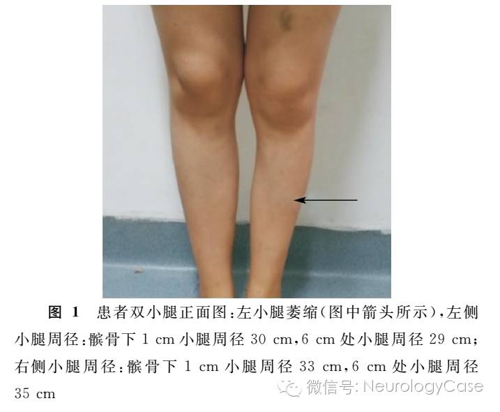 良性单侧下肢萎缩一例