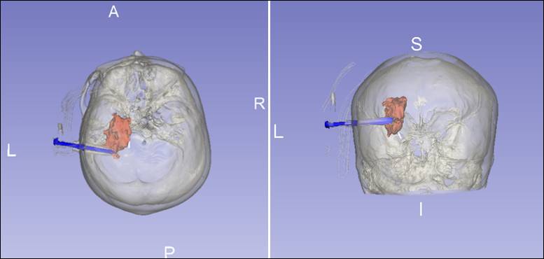 3dslicer增强现实体表投影在脑出血穿刺引流中的应用