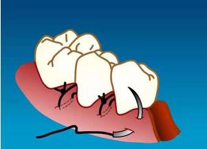牙周缝合常用的8种方法，不清楚的医生们注意了！