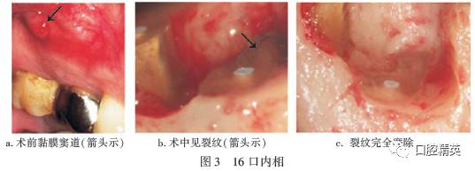 因右上后牙"牙龈脓包3d"来我院就诊.