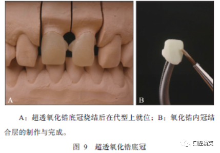 聚合瓷遮色铸造桩在前牙美学修复中应用1例