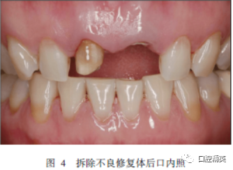 聚合瓷遮色铸造桩在前牙美学修复中应用1例