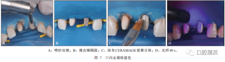 隔湿后在桩核表面涂布primer金属处理剂(shofu公司,日本),静置干燥10s