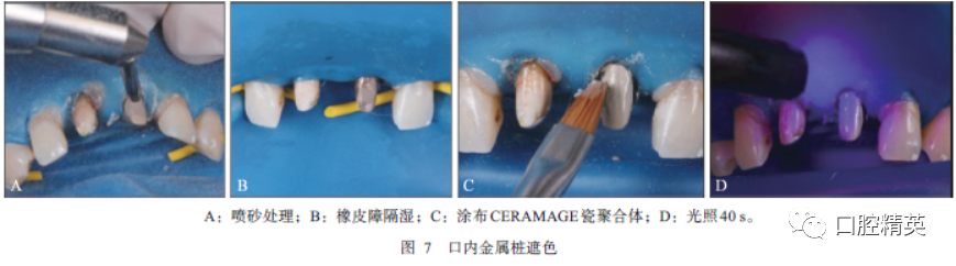 日本,静置干燥10s;于金属桩表面涂布一层ceramage瓷聚合体(shofu公司