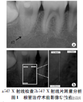 8mm,髓室底最高点至釉牙骨质界3.0mm(图1b.