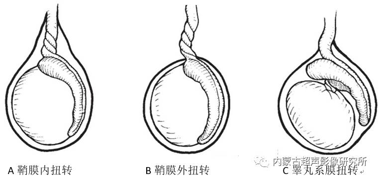 睾丸扭转坏死的超声诊断