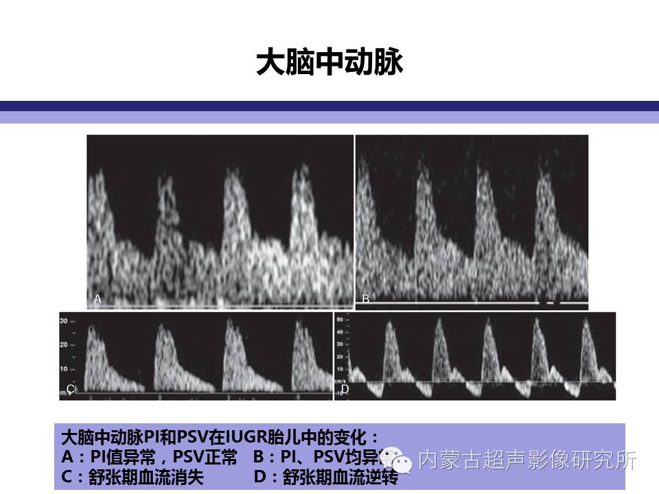 iugr 以往定义:是指胎儿体重低于同胎龄平均体重的第10个百分位数或