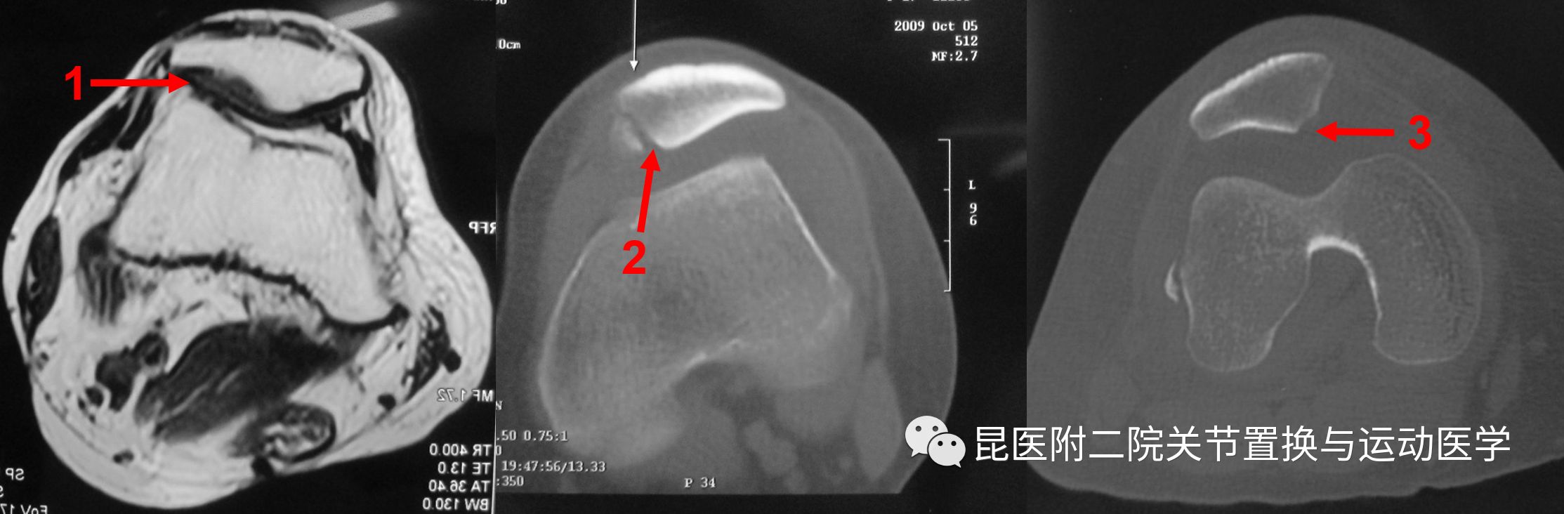 髌骨软骨面的损伤;2.髌骨内缘撕脱骨折;3.髌骨切线位骨折.