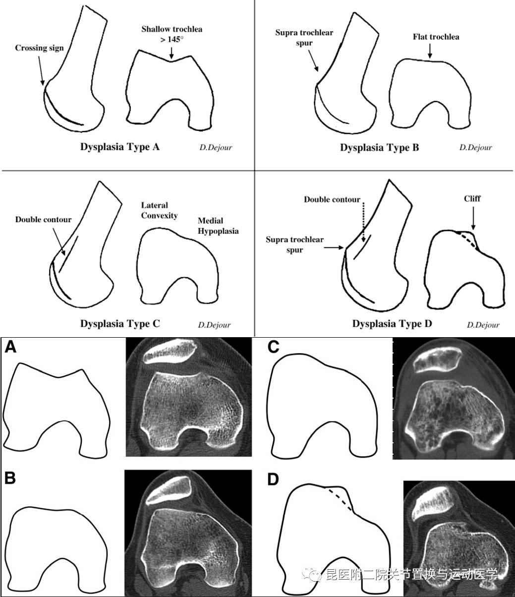 股骨滑车或股骨髁发育不良髌骨形态异常膝关节骨性组织或软组织发育