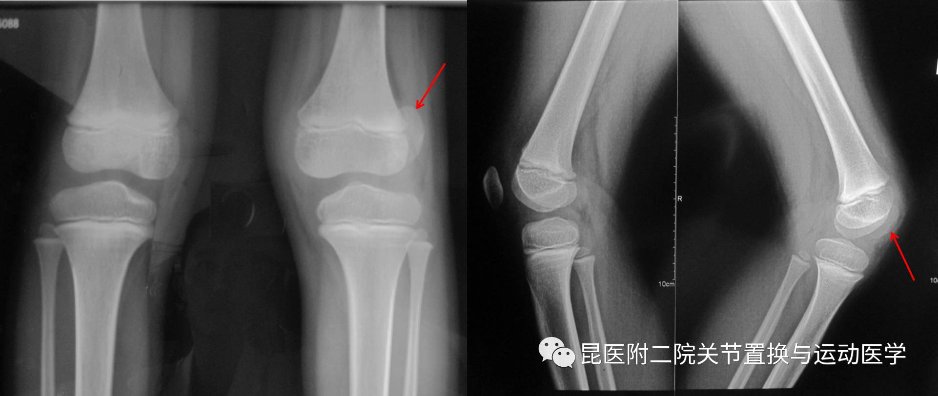 髌骨脱位容易忽视的膝盖扭伤张俊医生关节疾病小科普