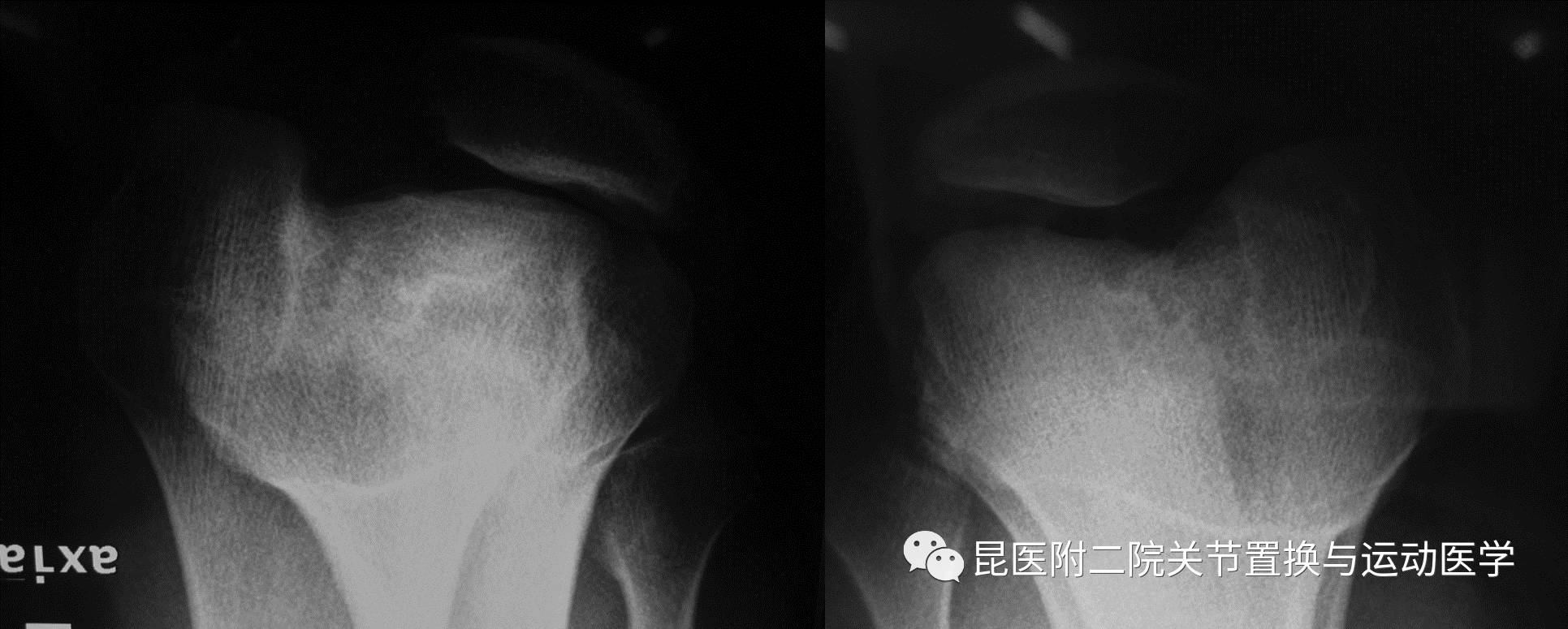 髌骨脱位容易忽视的膝盖扭伤张俊医生关节疾病小科普