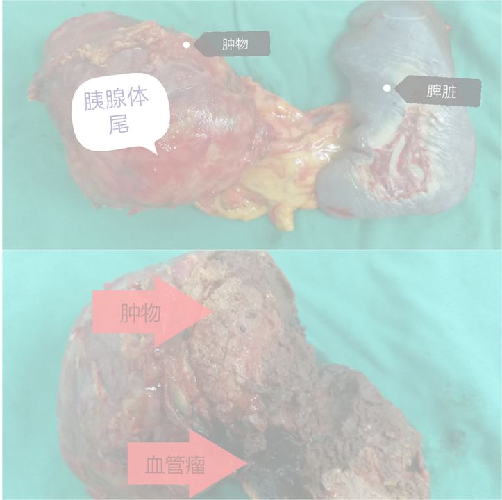 微创技术再上一个台阶 | 广西桂东人民医院自主切除一直径10cm胰腺