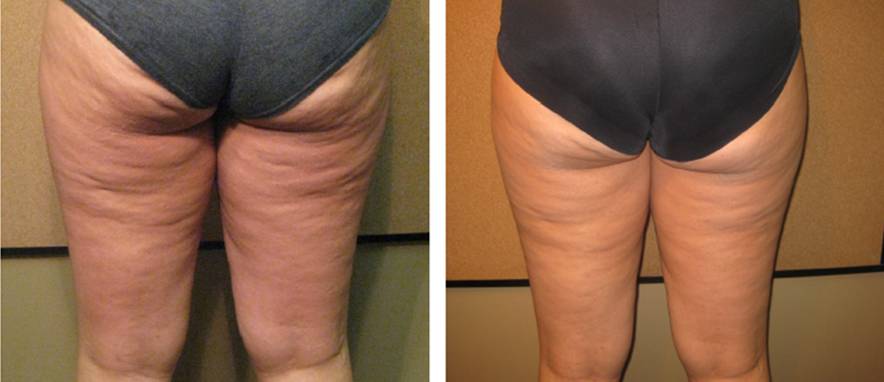 多极射频是什么紧致塑形——射频_https://www.jmylbn.com_新闻资讯_第9张