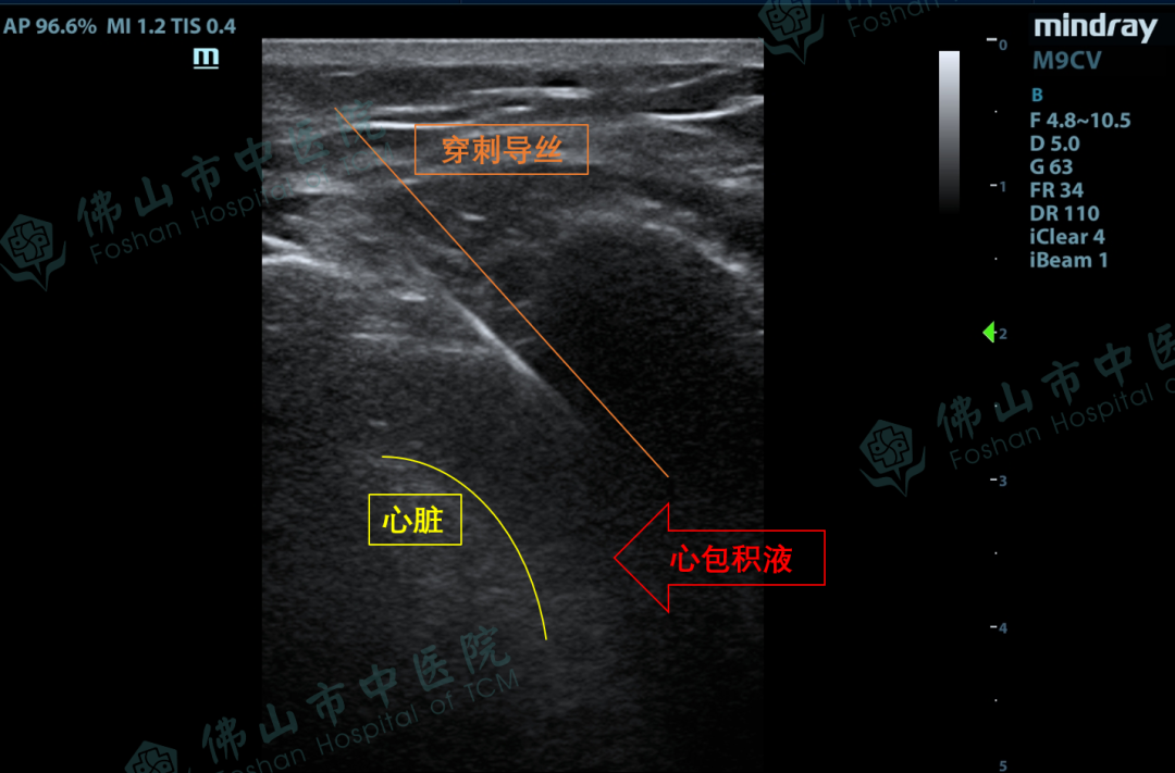 超声全程直视下行心包穿刺