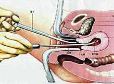人流刮匙有什么型号不明原因不孕、流产，你做子宫内膜活检了吗？_https://www.jmylbn.com_新闻资讯_第6张