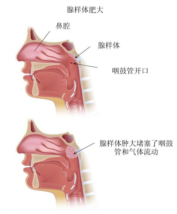 3岁之后,娃自身的抵抗力越来越强,腺样体的作用就逐渐弱化.