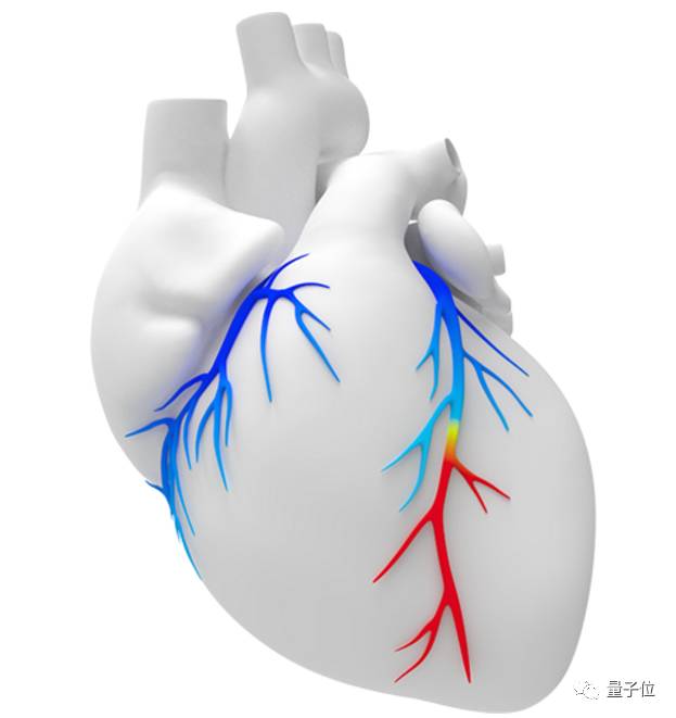 用深度学习检测冠心病：不依赖血管造影且成本下降25%