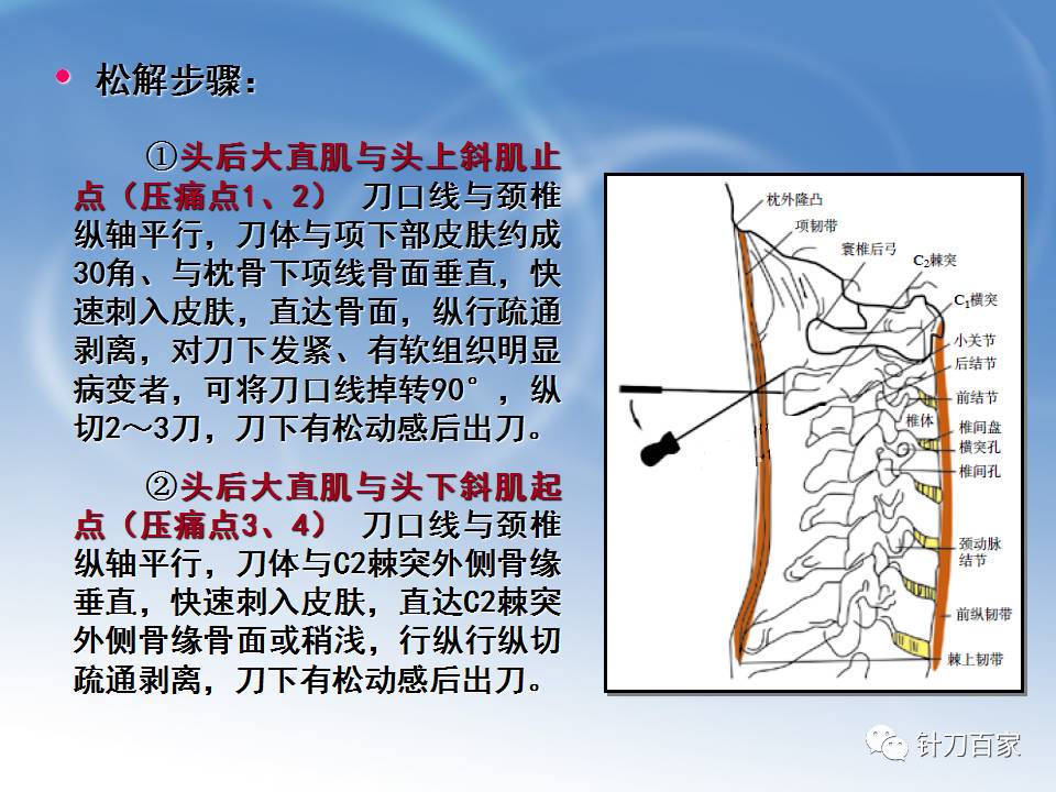 针刀松解术治疗颈椎病操作规范