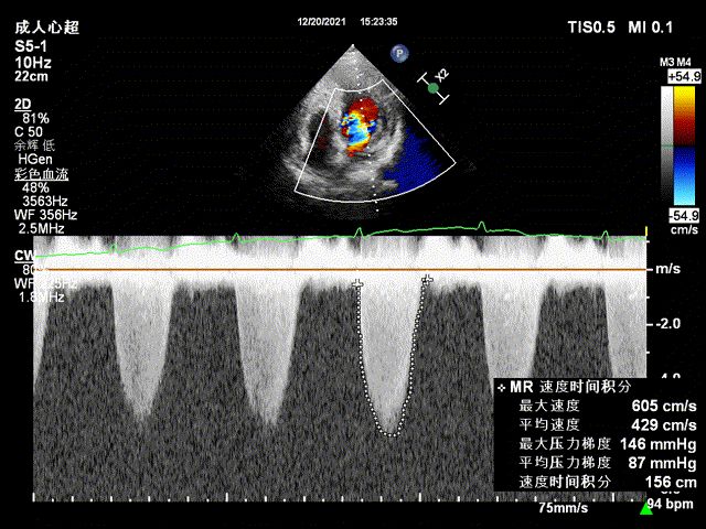 心脏彩色多普勒超声显示,ef:42%,左室舒末内径76,左室心尖部室壁瘤32*