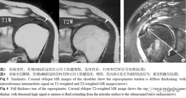 肩关节常见病变：MRI诊断